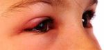 تورم چشم در نوزادان


چشم‌ها اعضای ظریفی هستند و هر مشکلی در آن‌ها ممکن است برای فرد آزار دهنده باشد در حالی که احتمالاً برای اطرافیان قابل مشاهده ...