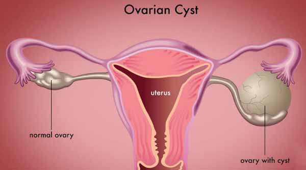 کیست های تخمدان بدون جراحی از بین می‌روند در مورد