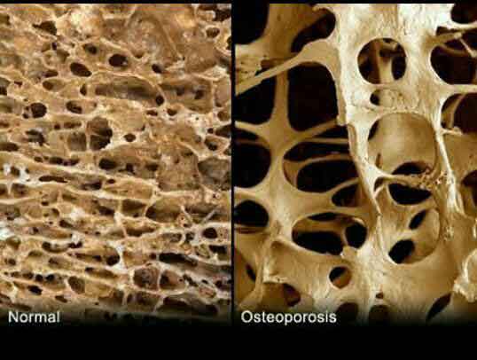 سمت‌ راست پوکی استخوان سمت چپ سالم پوکی_استخوان 