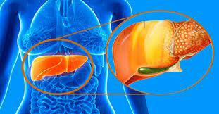بیماری خاموش کبد چرب زمانی متوجه خواهید شد که کبد