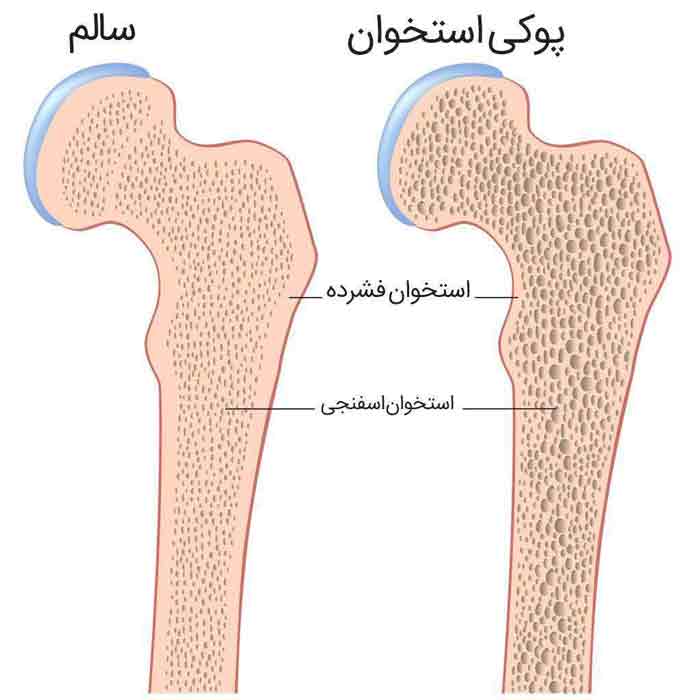 اگه میخواهید به پوکی_استخوان دچار نشوید، این معجو