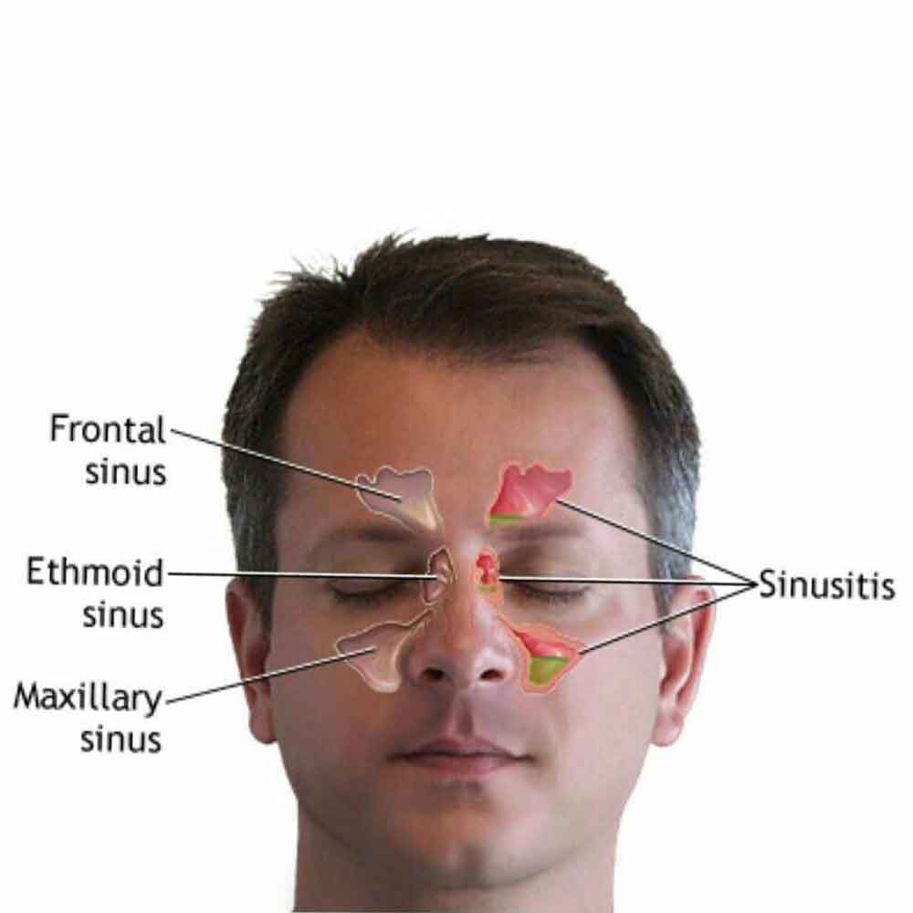 Лобный синус. Синусит гайморит фронтит. Синусит решетчатой пазухи. Верхнечелюстной синусит, фронтит, этмоидит.