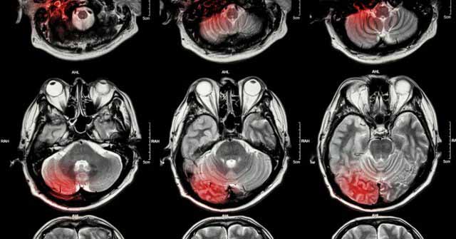 خارج کردن تومورهای مغزی با یک روش نوین دانشمندان 