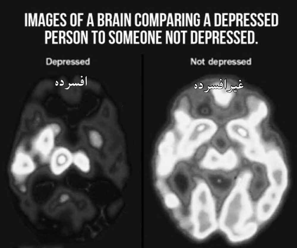 مقایسه تصویر مغز  سمت چپ فرد افسرده سمت راست فرد 
