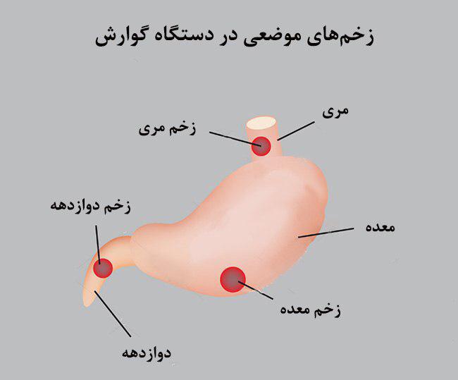 سنگین شدن معده از نتایج زخم معده  ⁣کاملا شایع است