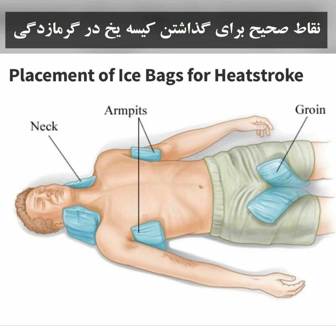 نقاط صحیح برای گذاشتن کیسه یخ در هنگام بروز گرماز