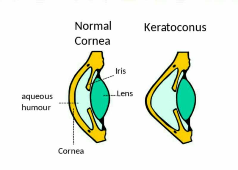مالش چشم باعث ابتلا به بیماری به نام کراتوکونوس م