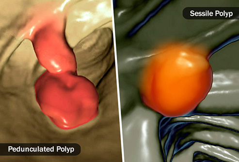آنچه شما باید درباره پولیپ بدانید