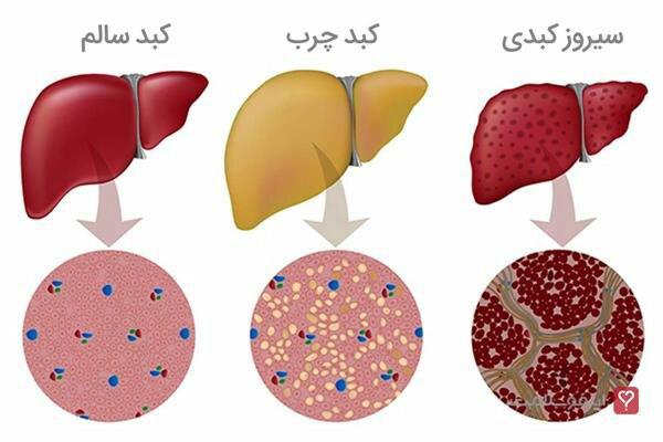 مواردی که در ایجاد کبد چرب میتونن نقش داشته باشن 