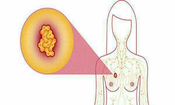 نشانه‌های سرطان سینه