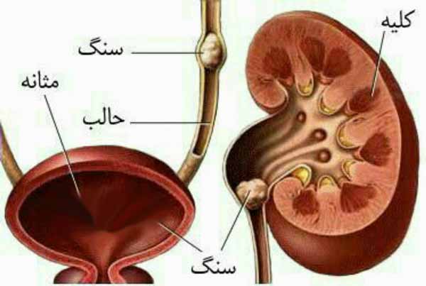 آیا میدانستید  شکر عامل ایجاد سنگ کلیه و سنگ مثان