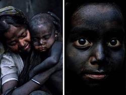 این کودکان هر روز سیاه تر می شوند + عکس