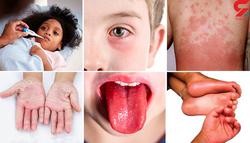 ضایعات پوستی کرونا در کودکان شدیدتر است / به شکل 