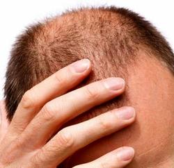 آیا کمبود مو را می توان نقص عضو دانست؟
