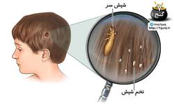 درمان خانگی شپش موی سر