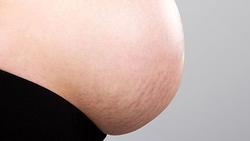چگونه از ترک های پوستی دوران بارداری جلوگیری کنیم