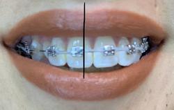 میدلاین دندان چیست و آیا تعیین میدلاین دندان اهمی