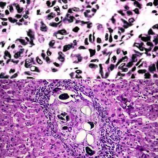 تصویری که می‌بینید کبد یک انسان مملو از تخم انگل 