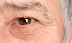 روش های درمان ورم اطراف چشم   ورم چشم (Periorbita