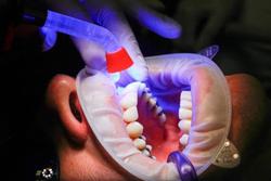 ایجاد اولین اطلس کامل سلولی دندان‌های انسان