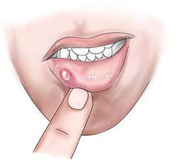 پیشگیری و درمان موکوسل دهانی