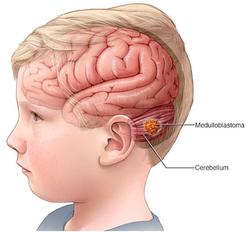 بیماری مدولوبلاستوما چیست و چگونه درمان می شود؟