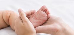 سرخک در نوزادان چه عوارضی دارد؟