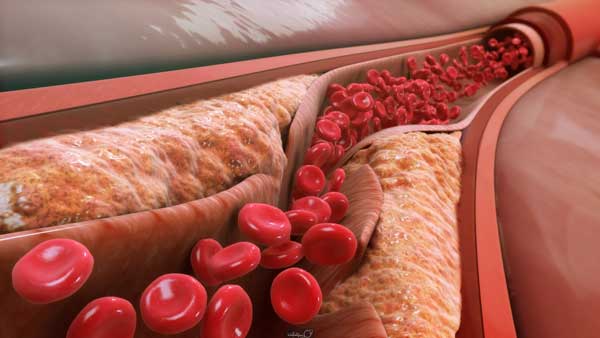 علائم کلسترول خون چیست