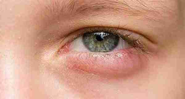 دلایل اصلی چشم درد چیست